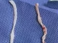 10-сантиметровых живых червей достали из руки китаянки после года боли