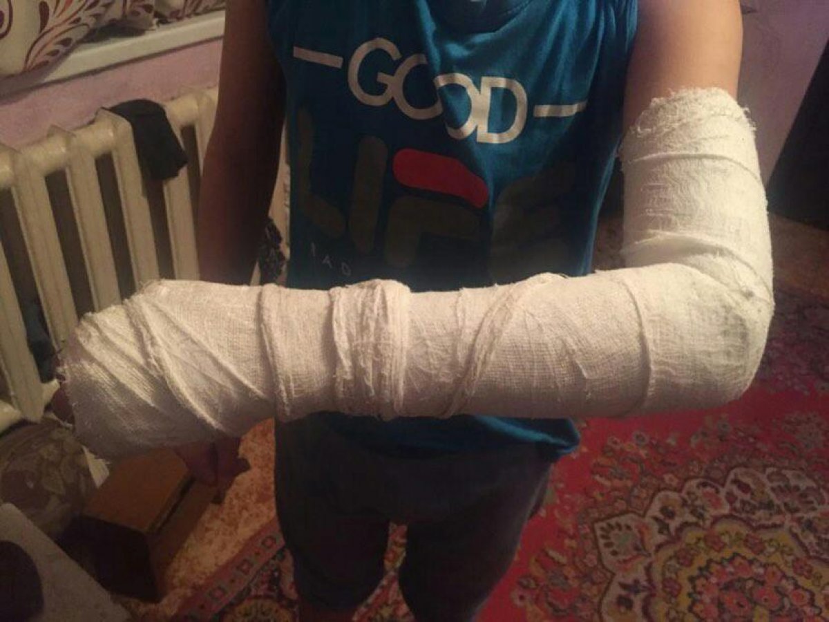 Ребёнок со сломанной рукой фото