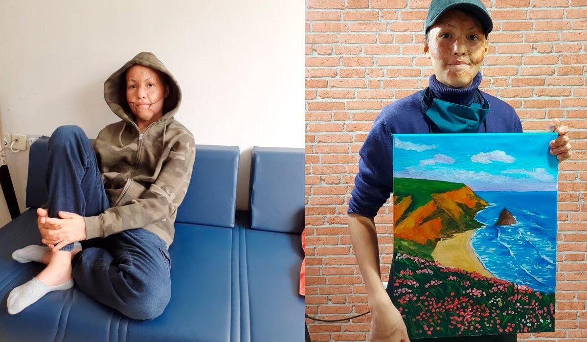 Лицо без шрамов. Как живет мальчик, рисовавший, чтобы оплатить операцию зарубежом