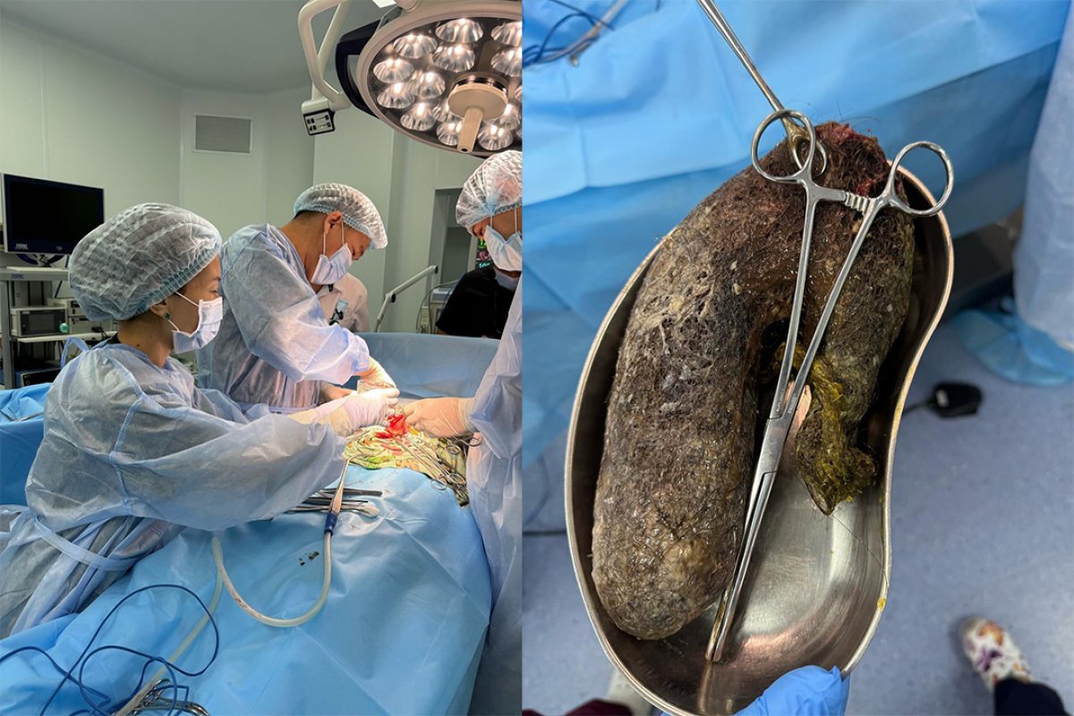 Алматинские хирурги удалили 1,5 кг волос из желудка пациентки