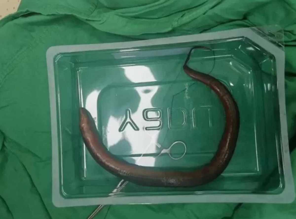 Хирурги обнаружили живого угря в животе мужчины