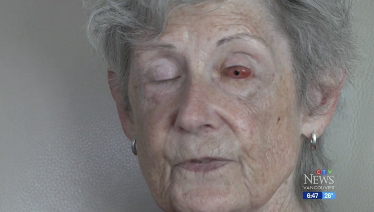 Врачам удалось вернуть зрение женщине, вставив ей зуб в глаз