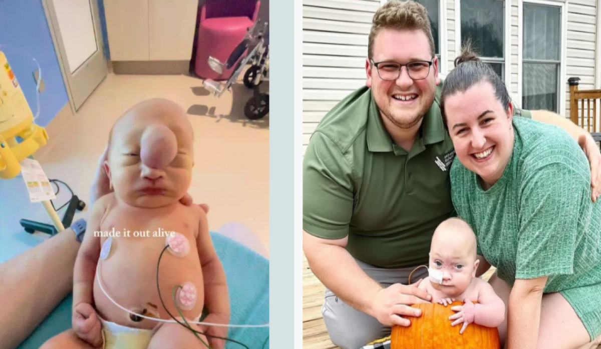 Мальчик с мозговой грыжей на лбу выжил и развивается вопреки прогнозам врачей