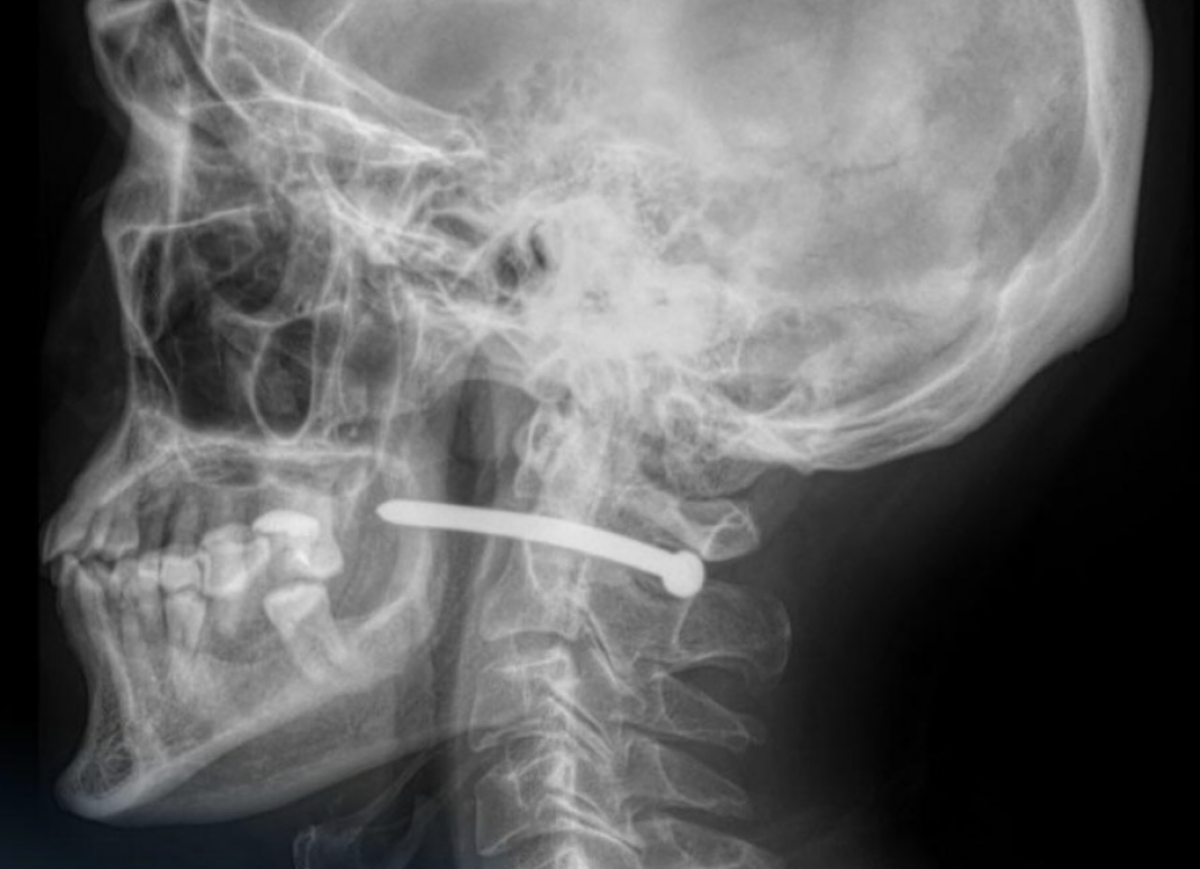 Гвоздь возле позвоночника: петропавловцу чудом удалось выжить