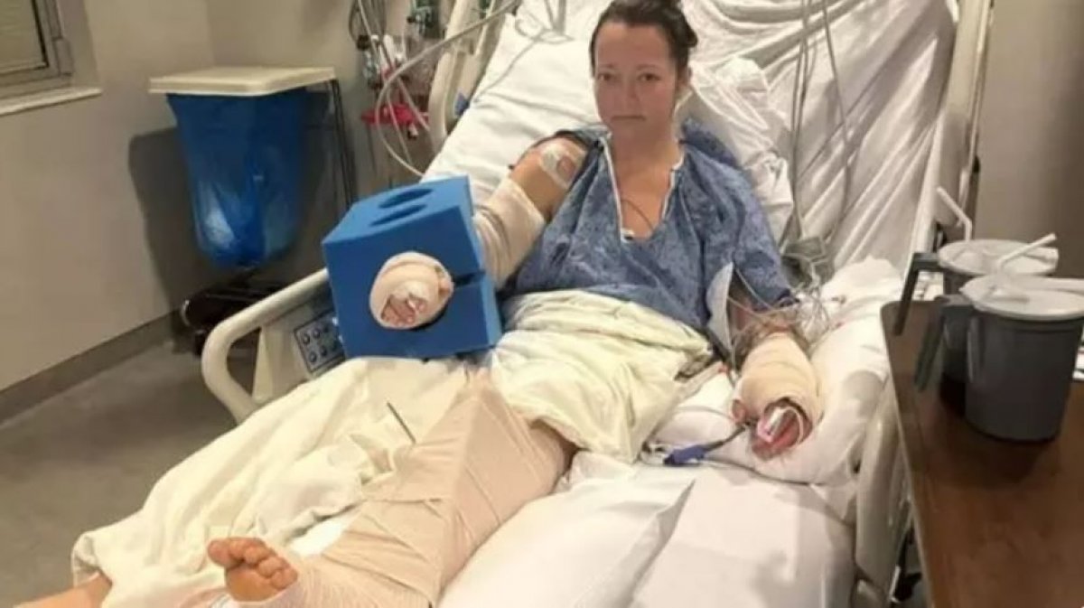 Женщина лишилась ноги после нападения питомца