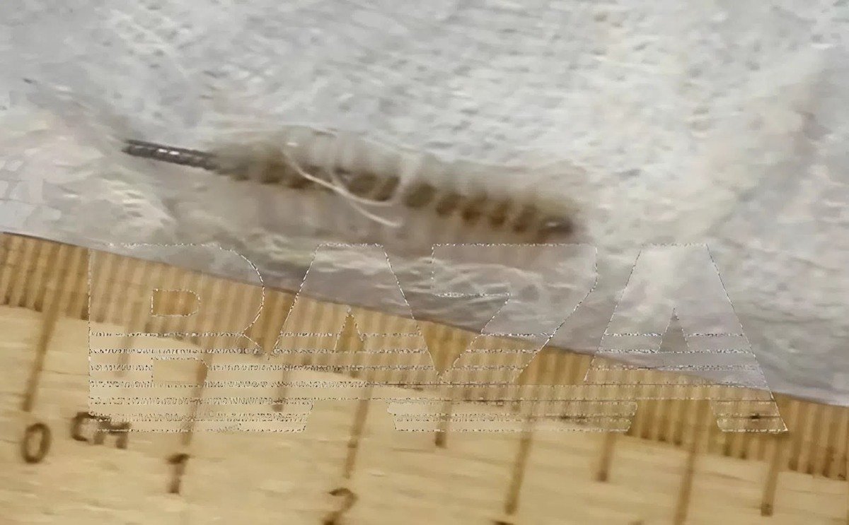 Забыли "ершик" в матке: гинеколог едва не погубила пациентку в России