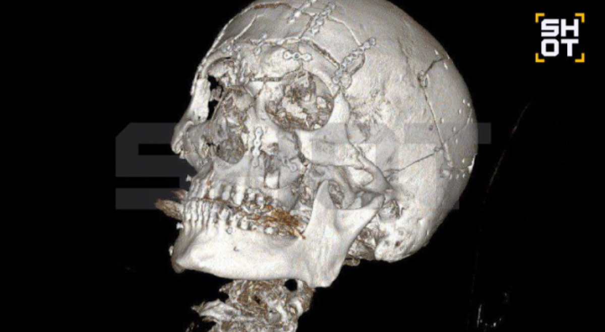 Собрали как пазл: мужчине раздробило лицо после падения со снегохода