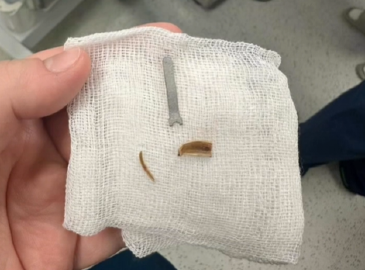 Железка месяцами скрывалась в легких ребенка из Мангистау