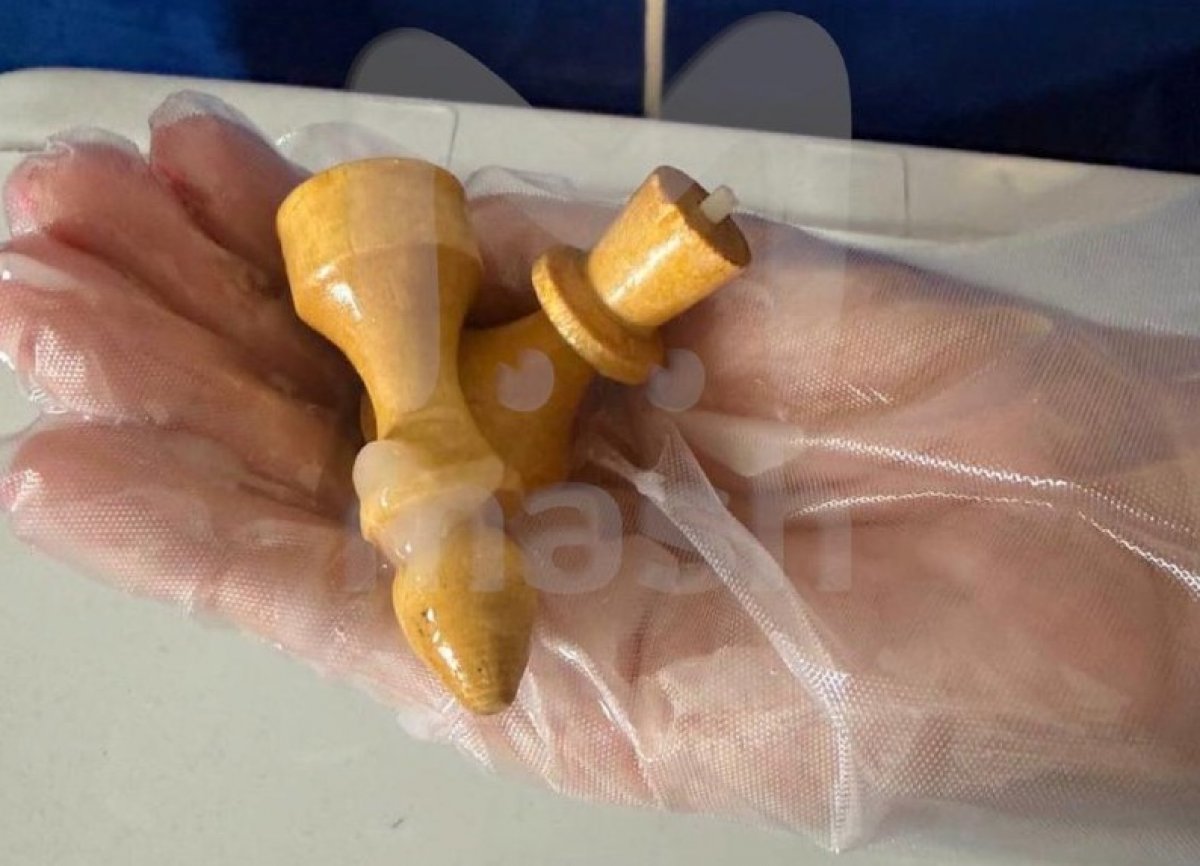 Две шахматные фигуры извлекли хирурги из прямой кишки мужчины