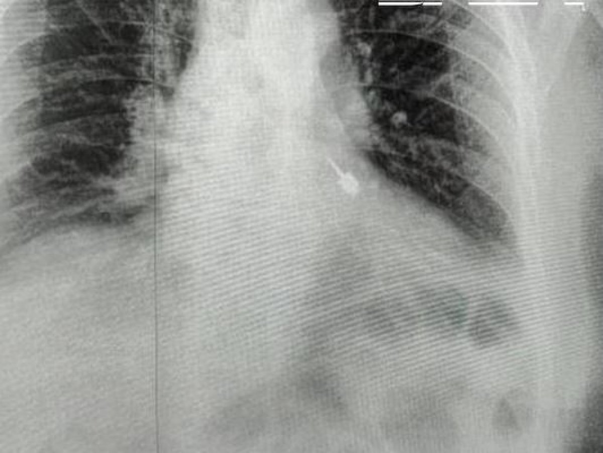 Бур провалился в бронхи пациента во время лечения зубов в России