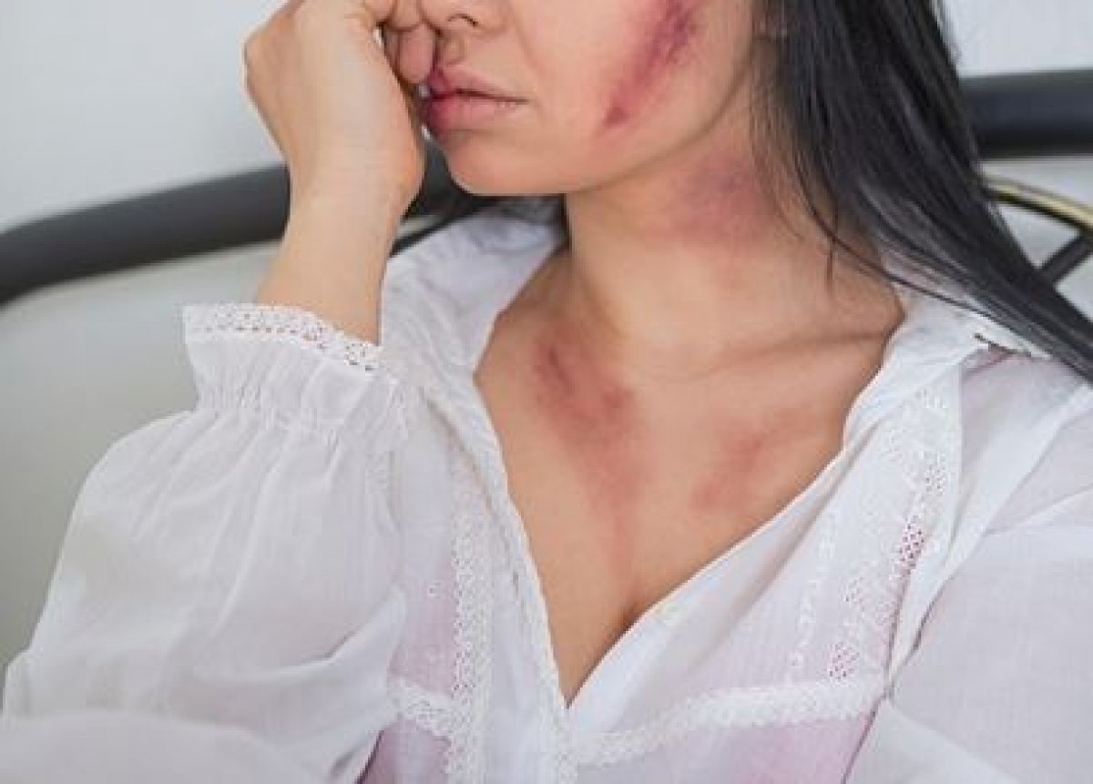 Женщину жестоко избили лопатой и сломали руки в Алматинской области