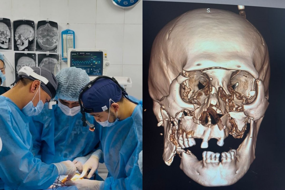 Уникальная 9-часовая операция вернула пациенту лицо и надежду в Алматинской области