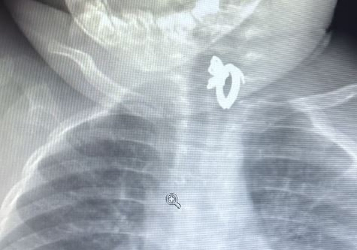 Серьга застряла в пищеводе годовалого ребенка в Туркестанской области