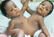 78 медработников 13 часов разделяли сросшихся близнецов в Нигерии