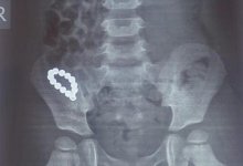 Врачи извлекли магнитный браслет из желудка маленького мальчика в Алматы