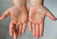 На информацию о вспышке синдрома Кавасаки в Казахстане ответил Минздрав