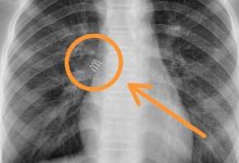 В Актау девочка почти год прожила с металлической пружиной в бронхах