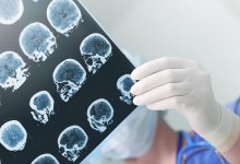 Провоцирует ли коронавирус инсульт. Казахстанские врачи поставили точку в вопросе