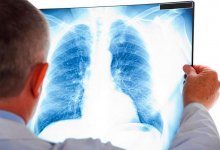 В Казахстане зафиксировано более 160 новых случаев пневмонии с признаками КВИ