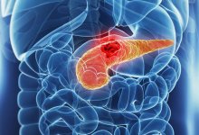 Врач раскрыл ранний симптом особо опасного рака