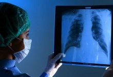 После коронавируса легкие полностью восстанавливаются, но не у всех – врач