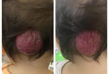 Опухоль размером с теннисный мяч удалили годовалой девочке врачи Нур-Султана