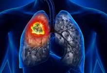 Доктор назвал главную причину рака легких