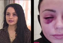 Астанчанка заявила, что почти лишилась зрения после пластической операции