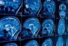 Коронавирус может вызвать болезнь Альцгеймера – ученые США