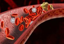 Врач рассказал, кому угрожает тромбоз при коронавирусе