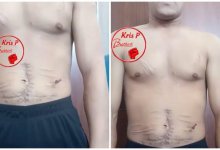 Заключенный с ранами на животе обвинил колонию Карагандинской области в пытках