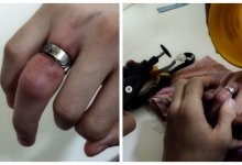 В Сарани десятиклассник чуть не лишился пальца, когда пытался снять кольцо