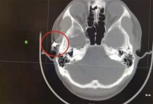 Китаец больше 20 лет прожил с пулей в черепе