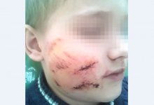 10 швов на лице: девятилетнего мальчика в Актюбинской области покусала соседская собака