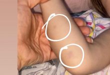 До синяков и ссадин: в частном саду в Семее избили маленького ребенка