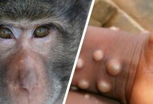 В Европе зафиксировали первый случай смерти от обезьяньей оспы