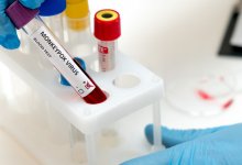 От обезьяньей оспы скончался 22-летний житель Индии