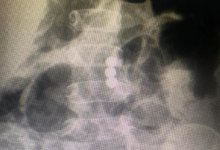 Проглотившего магниты малыша спасли врачи в Балхаше