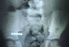 Магниты извлекли из кишечника мальчика в Кокшетау