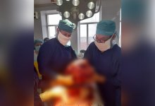 15-килограммовую опухоль удалили у жителя Атырау