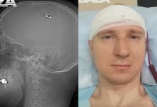 Россиянин чипировал себе мозг с помощью дрели в Алматы