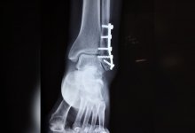 Грузовик раздробил ногу женщине в Алматы