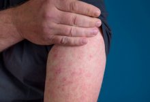 Вспышки кори продолжают фиксировать в западных регионах Казахстана