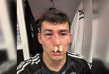 Бахтиеру Зайнутдинову разбили лицо во время матча в Турции