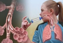 В Казахстане зарегистрирован новый генно-инженерный биологический препарат для борьбы с тяжелой бронхиальной астмой