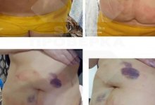 Десятки россиянок пострадали от липолитиков