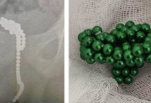 50 магнитных шариков нашли врачи в уретре подростка