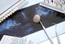 Потеряла зубы, атрофировалась челюсть: женщине неудачно установили импланты