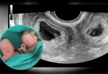 Женщина с двумя матками родила двойняшек в Китае