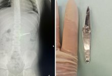 Шестилетний мальчик проглотил щипцы для стрижки ногтей